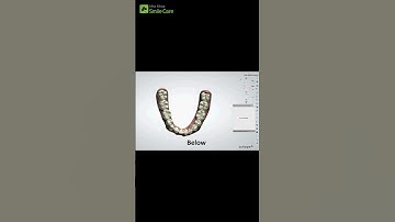 Smilesalign - Niềng khay trong suốt số 1 Việt Nam