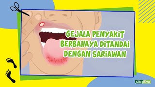 Inilah Penyebab dan Obat Sariawan Alami yang Baik Untuk Orang Dewasa dan Anak-anak screenshot 1