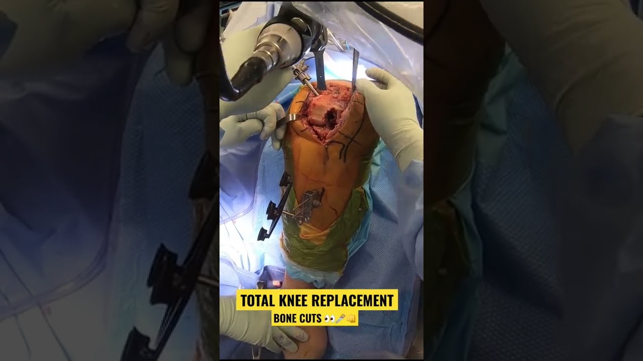 Total Knee Arthroplasty Shorts Bonecuts Orthopedics
