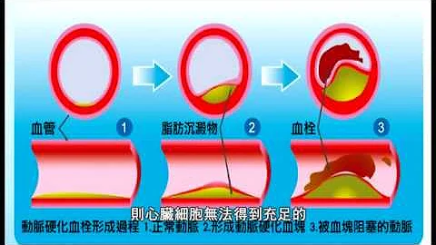 冠心病卫教_台湾介入性心脏血管医学会 - 天天要闻