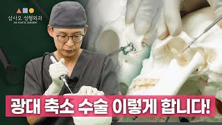 '광대 축소 수술' 실제로 어떻게 하는 지 보여드림! 이렇게나 많이 차이난다고?_[삼사오 성형외과]