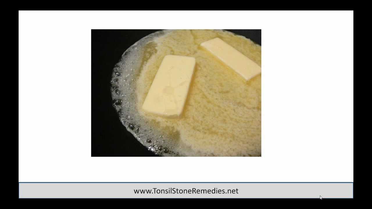 How To Prevent Tonsil Stones From Reoccurring? - YouTube