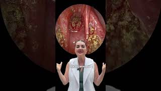 Amígdalas e Adenóide: Antes e Depois da Cirurgia #shorts