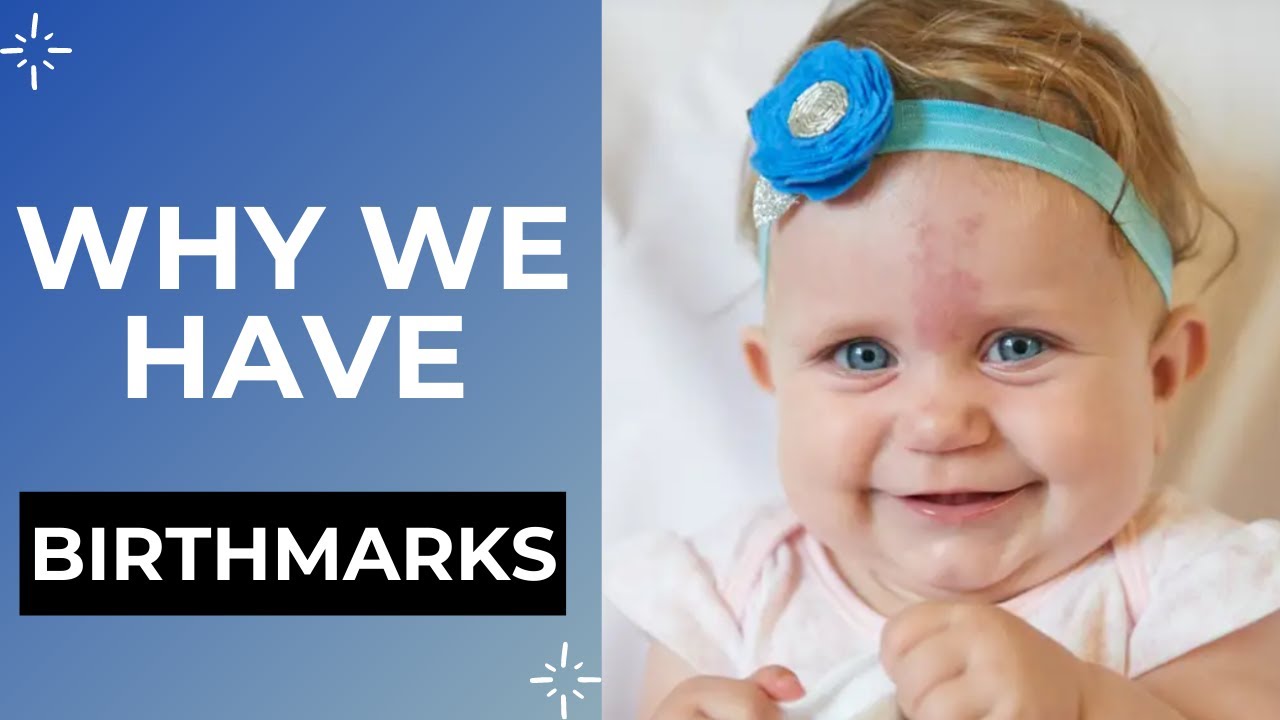 The Reason we have Birthmarks on our Body | What they mean | How are ...