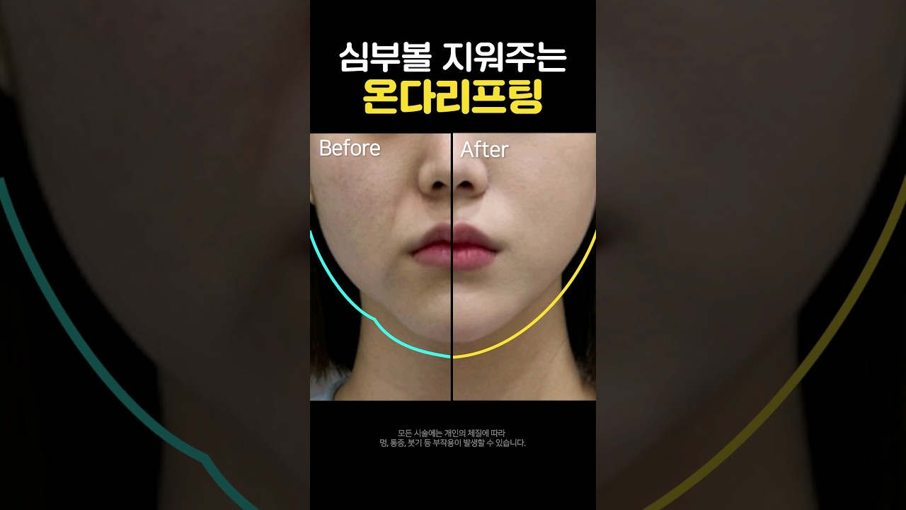 Лиенжанг гоо сайхны мэс заслын эмнэлэг Онда лифтинг #богино_бичлэг