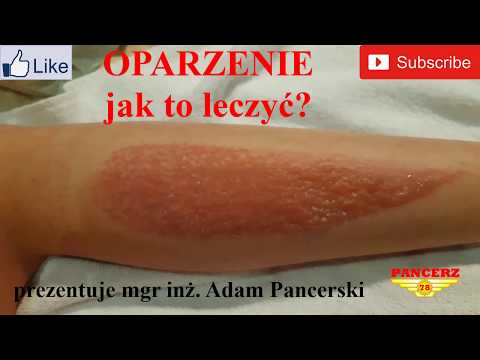 Wideo: Jak leczyć oparzenia dywanu (ze zdjęciami)