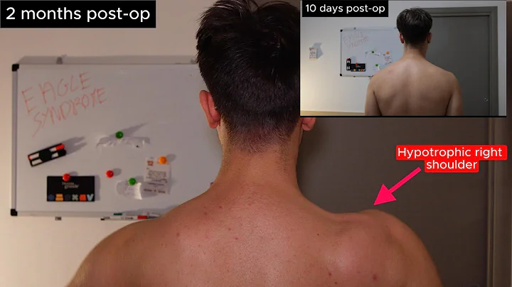 HEALING UPDATE : 2 MONTHS POST SURGERY. -Jugular vein decompression-