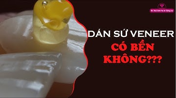 Dán sứ veneer có bền không | Tt niềng răng quốc tế Diamond