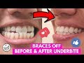 BRACES OFF, UNDERBITE CORRECTED! Getting my adult braces removed and having my underbite corrected