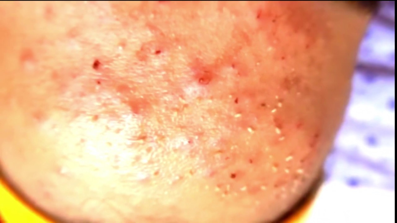Greatest Blackheads and Whiteheads removal [Ep001] YouTube