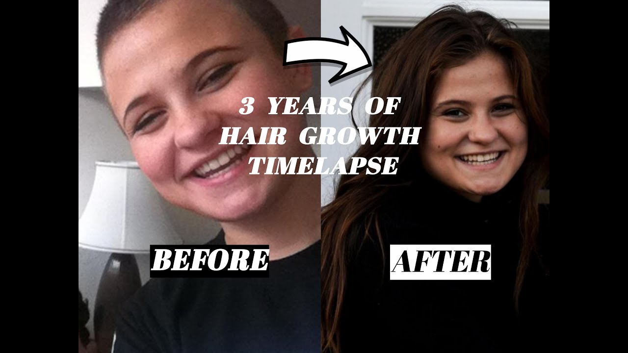 3 Years Of Hair Growth From BALD (TIMELAPSE) - YouTube