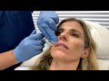 Film Starlette Cory Chase Gets Plump Lips With Restylane Kysse OceanDrivePlasticSurgery Com 