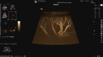 LOGIQ P9 Tutorials: B-Flow