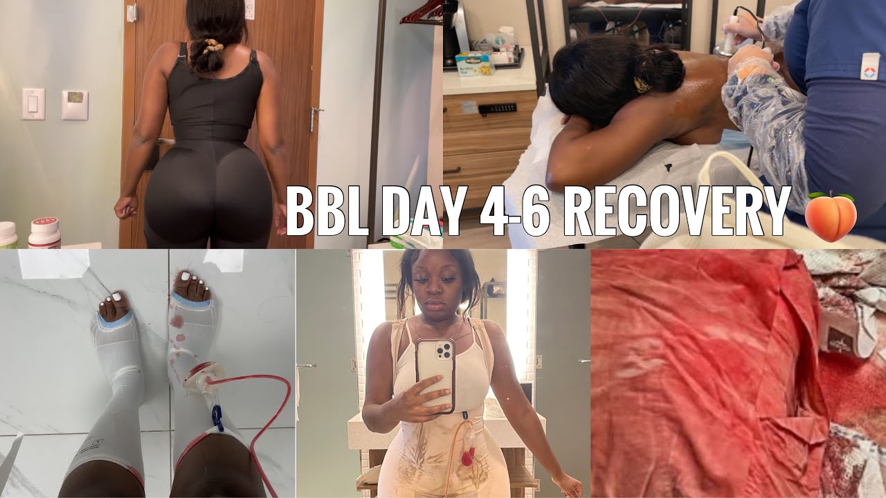BBL RECOVERY DAY 46 RAW & UNCUT DRAINS, MASSAGES, STAGE 2 FAJA