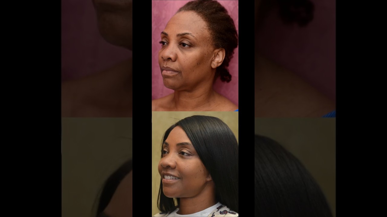 Best Facelift (Rhytidectomy) Encino & Bakersfield | Sean Younai, MD