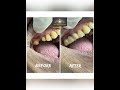 Replace your Missing Tooth now with a Fixed Tooth!! | The Dental Home Clinic | Dr Kunal Rajyan