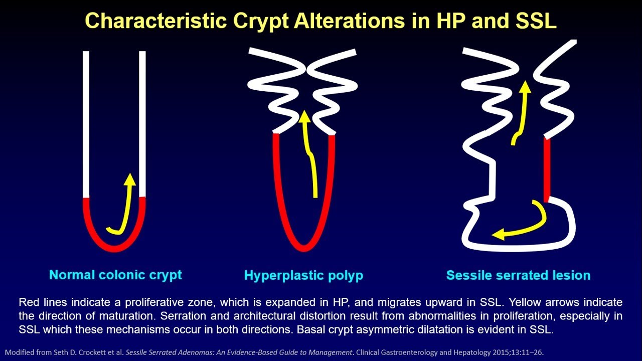 Patho Minutes Hyperplastic Polyp Vs Sessile Serrated Lesion Youtube