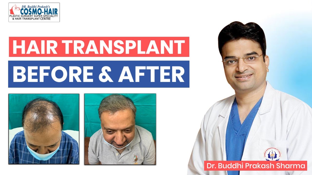 Hair transplant Types Advantages Procedures and More RichFeel