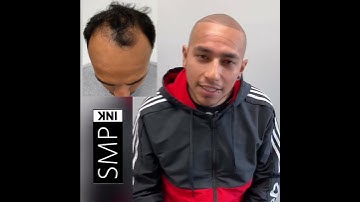 Before and After of a Successful Scalp Micropigmentation Session!