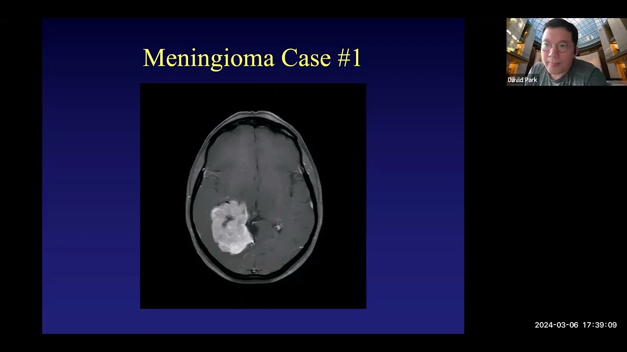 Treatment of Meningiomas - A Panel Discussion with Dr. David Park and Dr. Amid Persad