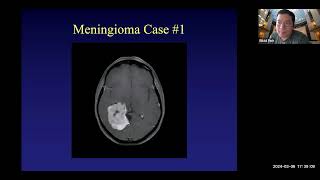 Treatment of Meningiomas - A Panel Discussion with Dr. David Park and Dr. Amid Persad