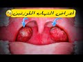 أعراض التهاب اللوزتين 