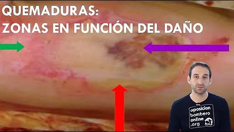 ¿Qué aspecto tiene una quemadura infectada?