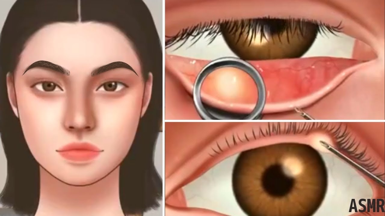 ASMR Satisfying, eye stye treatment animation eye pimple YouTube