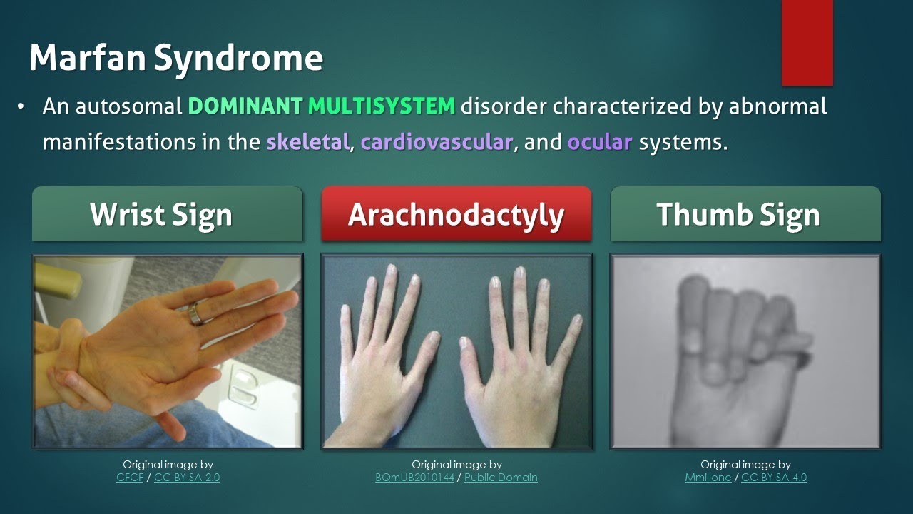 Marfan Syndrome - YouTube