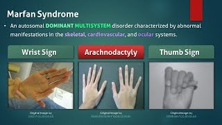 Marfan Syndrome