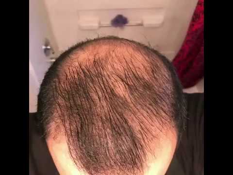 can minoxidil work in a month