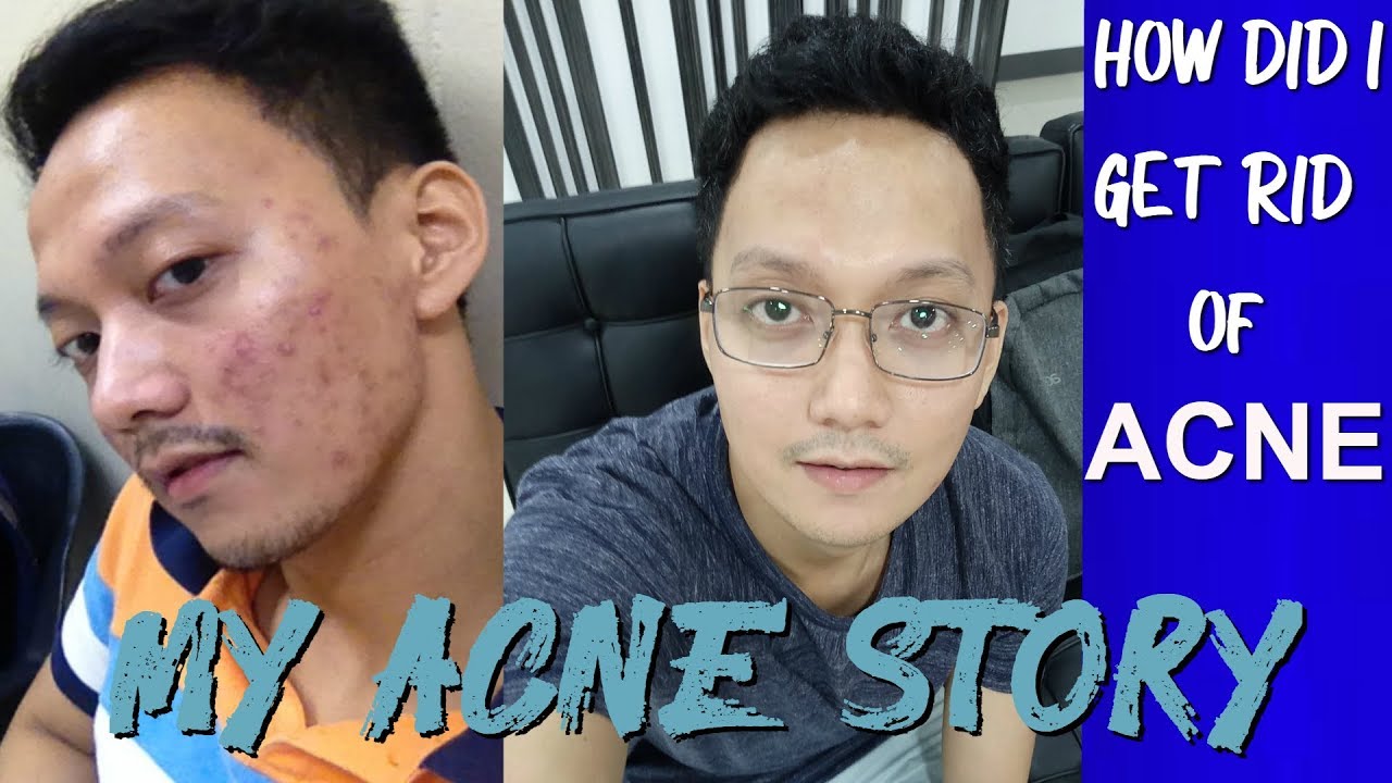 My Acne Story | How I Got Rid of Acne - YouTube