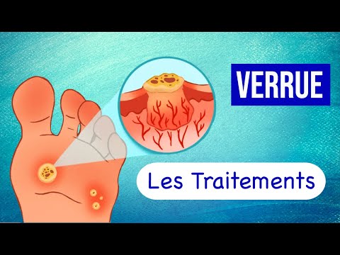 Vidéo: Comment traiter les ampoules mineures (avec photos)