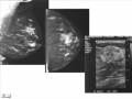 Breast Ultrasound Indications Technique Normal Anatomy