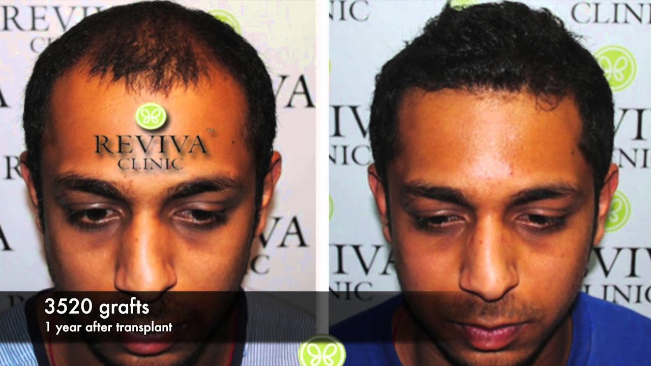 AMAZING HAIR TRANSPLANT RESULTS - YouTube