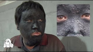 Man with Blackened Face Wanders with Sister for 10 Years, Heartbreaking Story Behind Their Journey