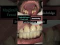 Missing teeth treatment 9643212127