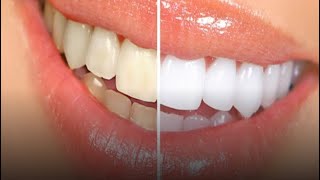 خلطة سحرية لتبيض الاسنان وازالة الكالكير وعلاج اللثة النتيجه من الاستعمال الاول