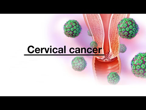 Mayo Clinic Minute - Why Black women need to get screened for cervical cancer 
