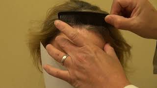 Hair Loss Treatment for Men | [Type of transplant] (# Hair grafts)