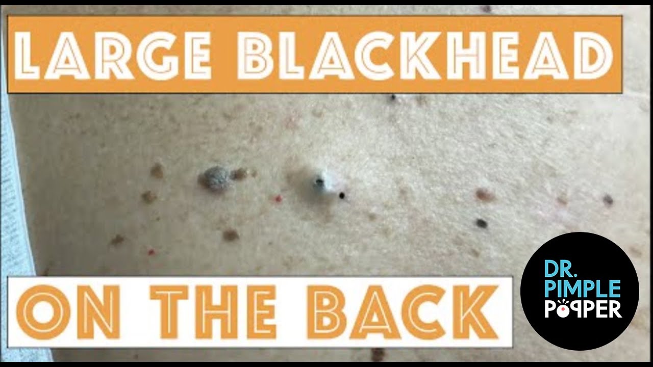 Large Blackheads on the Back - YouTube