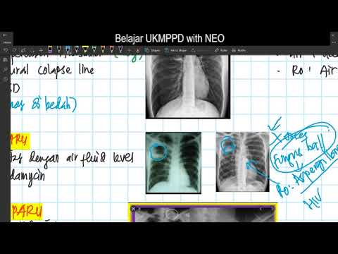 BELAJAR UKMPPD: PULMONOLOGI PART 3 (Pneumonia, Bronchiolitis et al, Pneumoconiosis, Bagossosis)