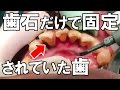歯石除去治療 a tooth fixed with heavy tartar 【 dentistry】 [ cleaning]歯石除去Vol.1(去牙石治療)