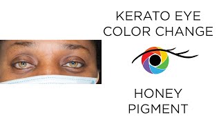 Eye Color Change from Dark to Light Brown with Kerato (Honey Pigment)