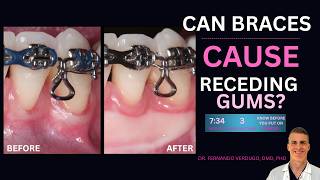 Can Braces Cause Receding Gums? | Risks, Warning Signs & What to Do
