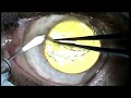 Chirurgie de kratectomie superficielle traitement de lulcre  bords dcolls