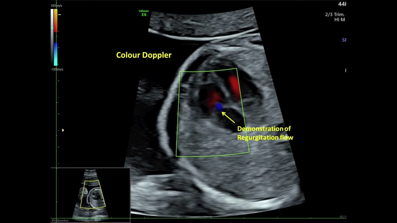 Trivial Tricuspid Valve Regurgitation Fetal Echo YouTube Trivial Tricuspid Valve Regurgitation Fetal Echo YouTube