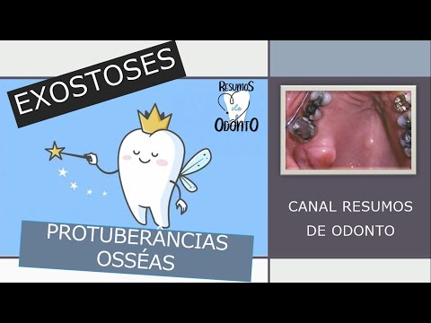 Vídeo: Exostoses múltiplas hereditárias são dolorosas?