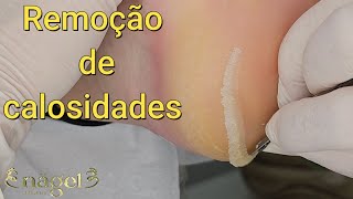 PASSO A PASSO DA REMOÇÃO DE CALOSIDADES satisfying viral