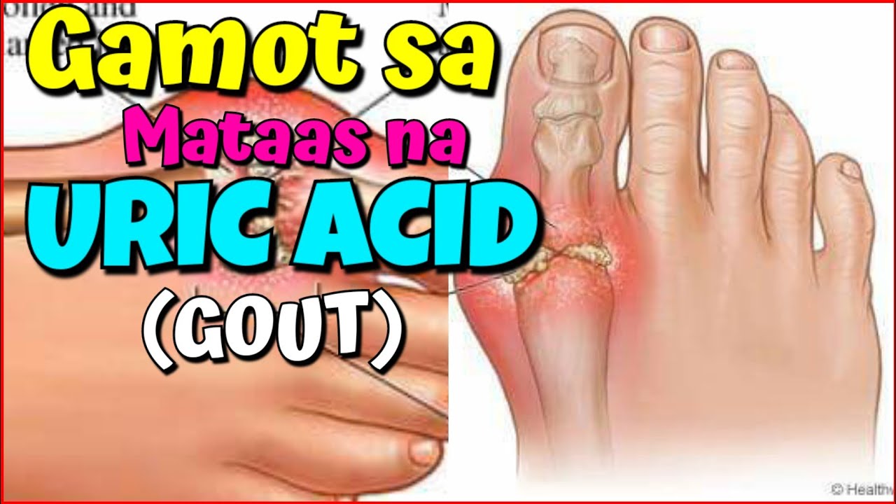 Sintomas Ng Uric Acid MATAAS NA URIC ACID AT GOUTY ARTHRITIS| MGA PAGKAIN DAPAT IWASAN NG MAY